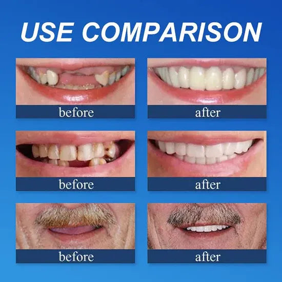 🌎Ends Today: 49% OFF!⏰KLENIMORE™ Custom-Fit Smile Support Kit — Strong Suction Feel & Natural-Looking Fit