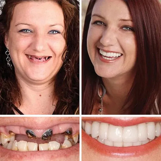 🌎Ends Today: 49% OFF!⏰KLENIMORE™ Custom-Fit Smile Support Kit — Strong Suction Feel & Natural-Looking Fit