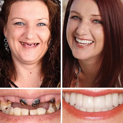 🌎Ends Today: 49% OFF!⏰KLENIMORE™ Custom-Fit Smile Support Kit — Strong Suction Feel & Natural-Looking Fit