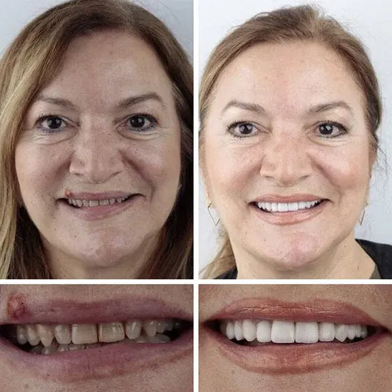 🌎Ends Today: 49% OFF!⏰KLENIMORE™ Custom-Fit Smile Support Kit — Strong Suction Feel & Natural-Looking Fit